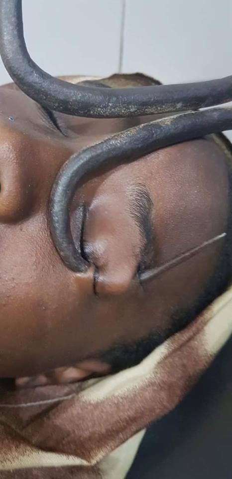 Doctors rescue little girl after Iron hook passed through her eyes (graphic photos)