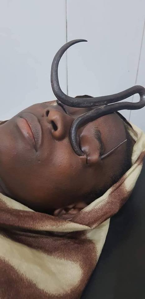 Doctors rescue little girl after Iron hook passed through her eyes (graphic photos)