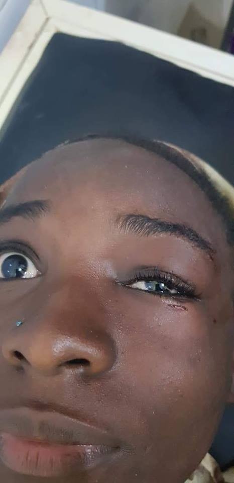 Doctors rescue little girl after Iron hook passed through her eyes (graphic photos)