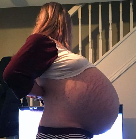 See what doctors found in the tummy of a woman they thought was pregnant with multiple babies
