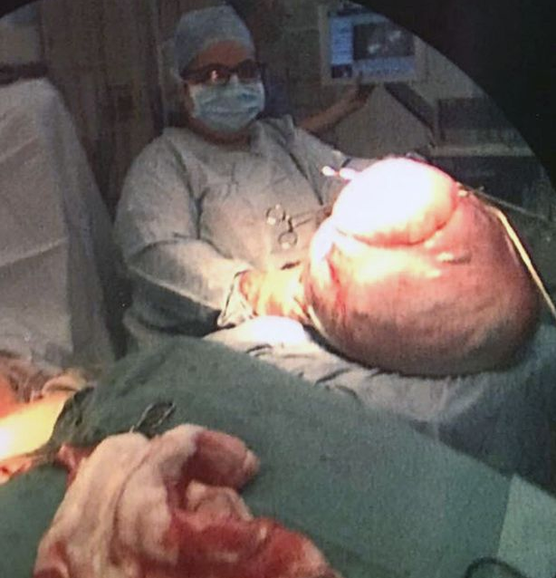 See what doctors found in the tummy of a woman they thought was pregnant with multiple babies