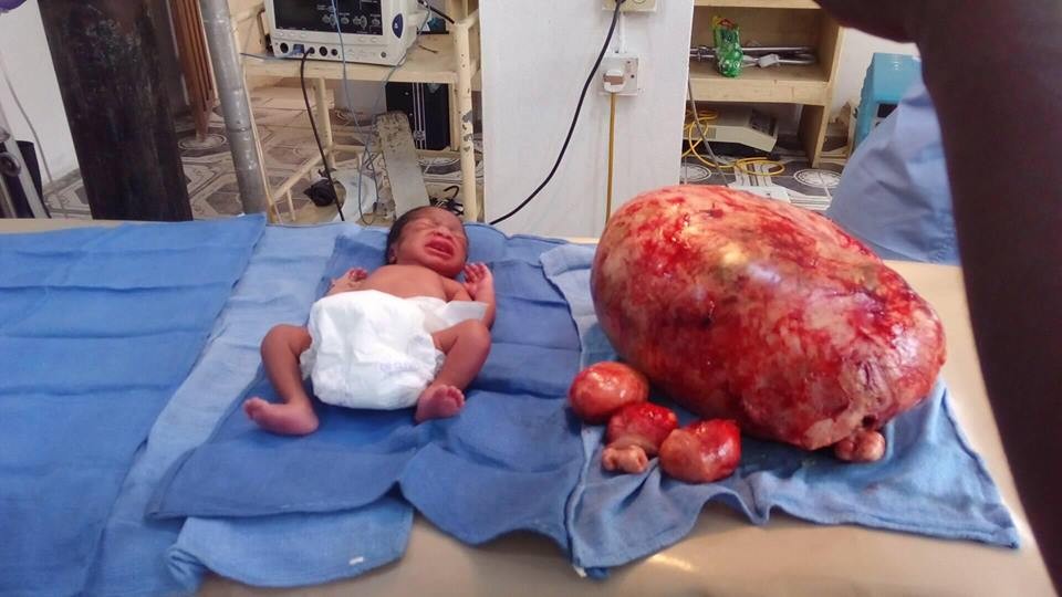 Wow! See the massive fibroid that was removed from a woman while she gave birth in Nigeria