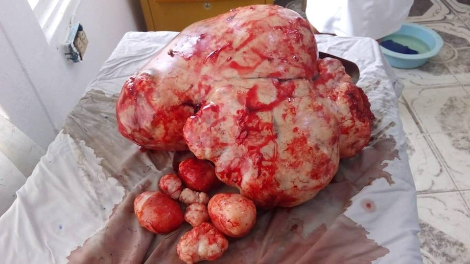 Wow! See the massive fibroid that was removed from a woman while she gave birth in Nigeria