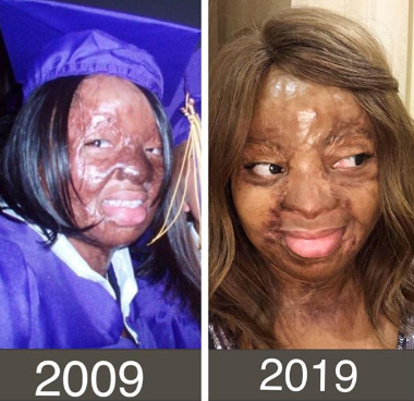Sosoliso plane crash survivor, Kechi