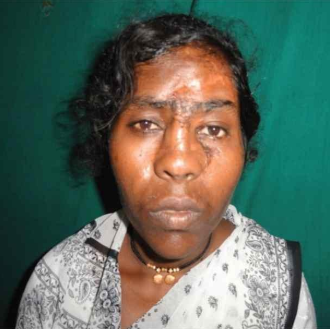 Doctors reconstruct the face of a woman after it was torn by her husband and it