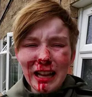 Teenage girl left with bloodied face after homophobic attack