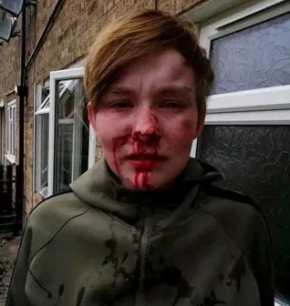 Teenage girl left with bloodied face after homophobic attack