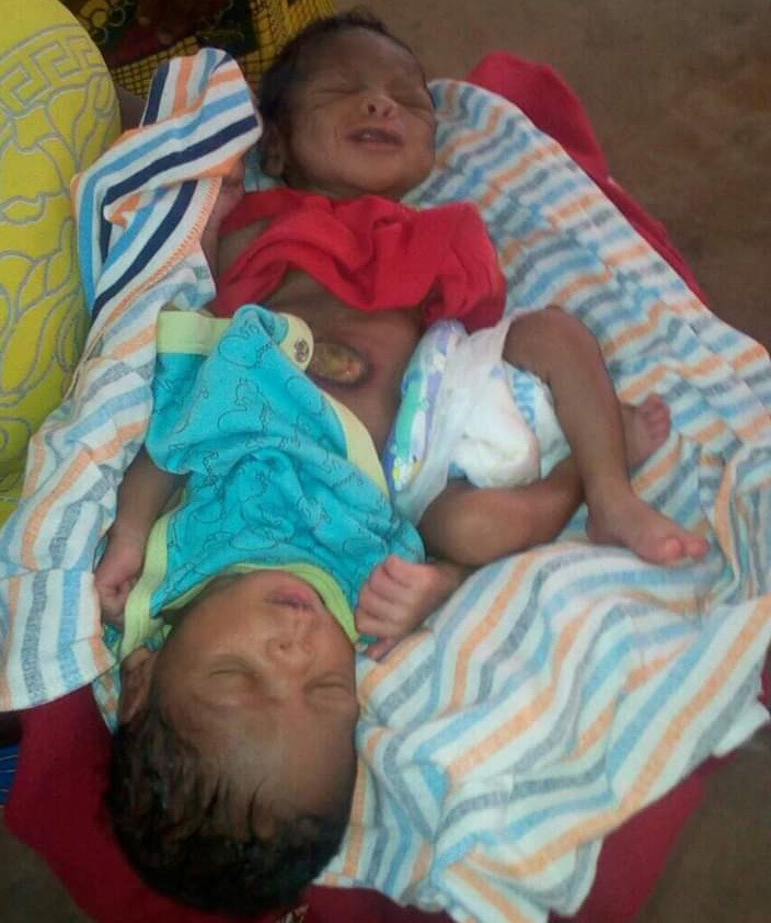 Photos: Woman gives birth to conjoined twins in Benue