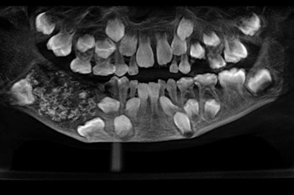 Doctors remove 526 teeth from a 7-year old?boy