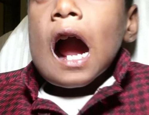 Doctors remove 526 teeth from a 7-year old?boy