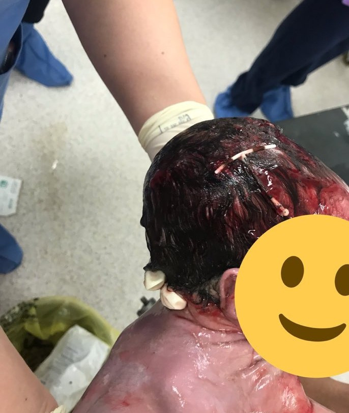 Viral photo of a baby born with birth control implant on the head