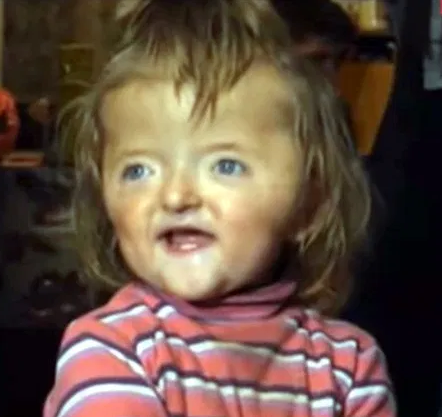 Toddler banned from attending nursery because deformed skull ?would scare other children?