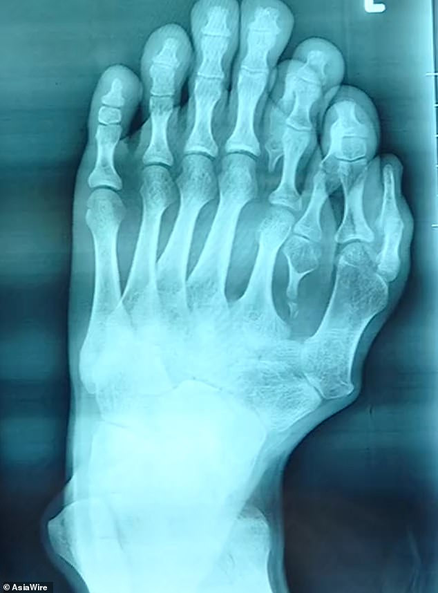 Chinese man born with nine toes undergoes surgery to cut off four of them