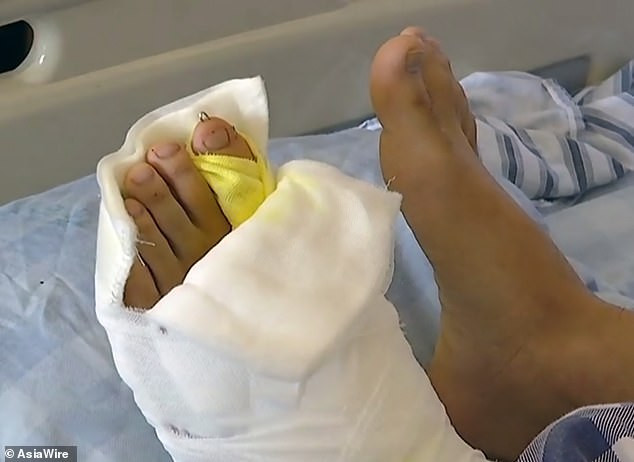 Chinese man born with nine toes undergoes surgery to cut off four of them