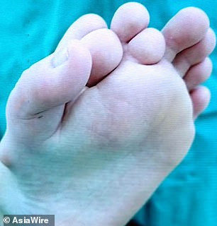 Chinese man born with nine toes undergoes surgery to cut off four of them