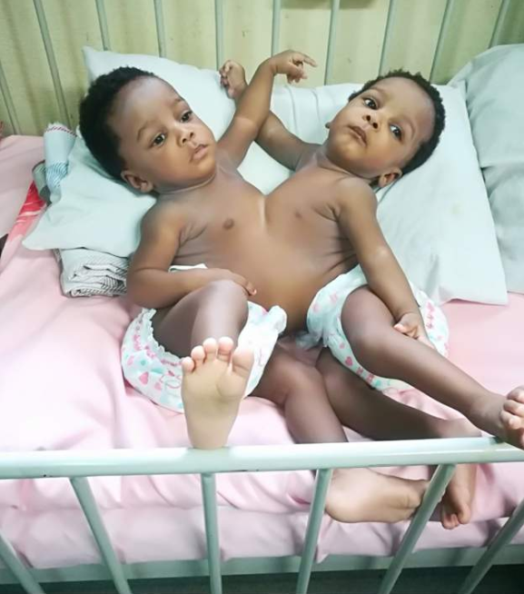 Nigerian doctors separate conjoined twins (photos)