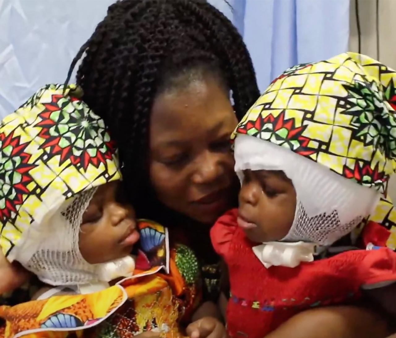 Twins conjoined at the head separated successfully in first-of-its-kind surgery