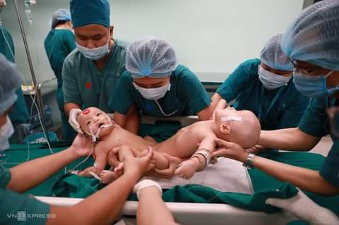 Conjoined twins discharged from hospital after successful separation