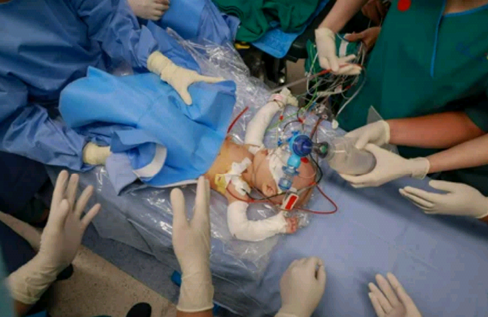 Conjoined twins discharged from hospital after successful separation