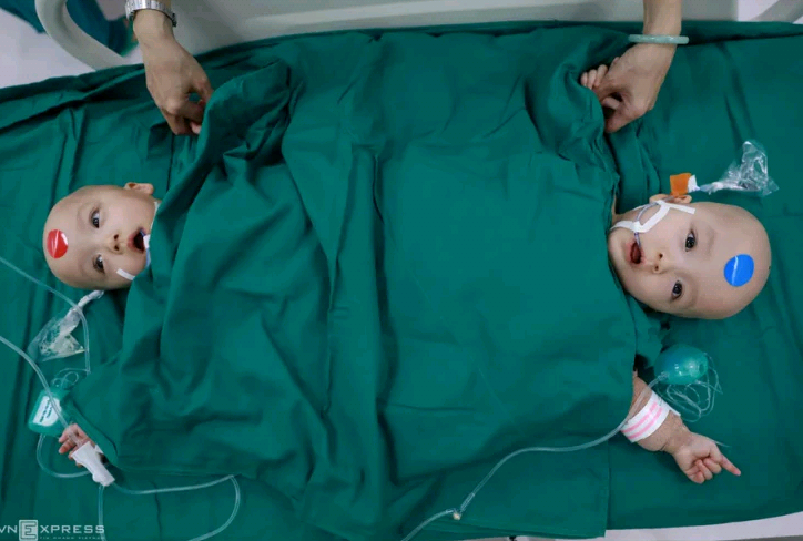 Conjoined twins discharged from hospital after successful separation