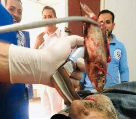 Moment doctors remove live fish from a fisherman