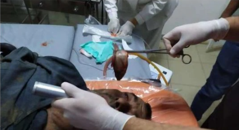 Moment doctors remove live fish from a fisherman