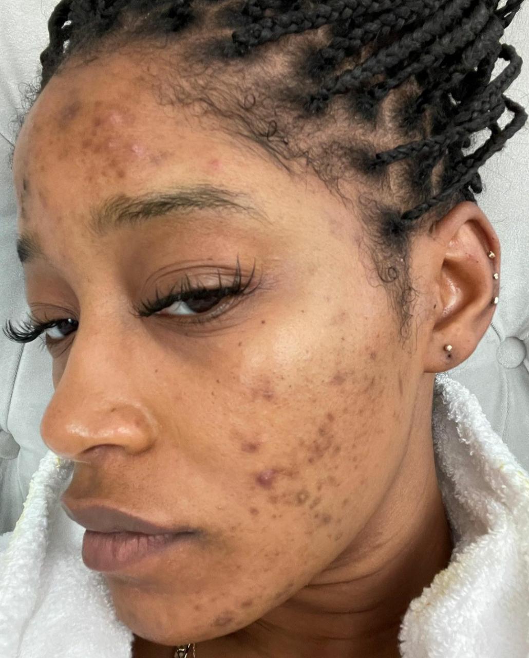 "My skin has made me sad many nights" Keke Palmer says as she reveals her struggle with acne caused by PCOS