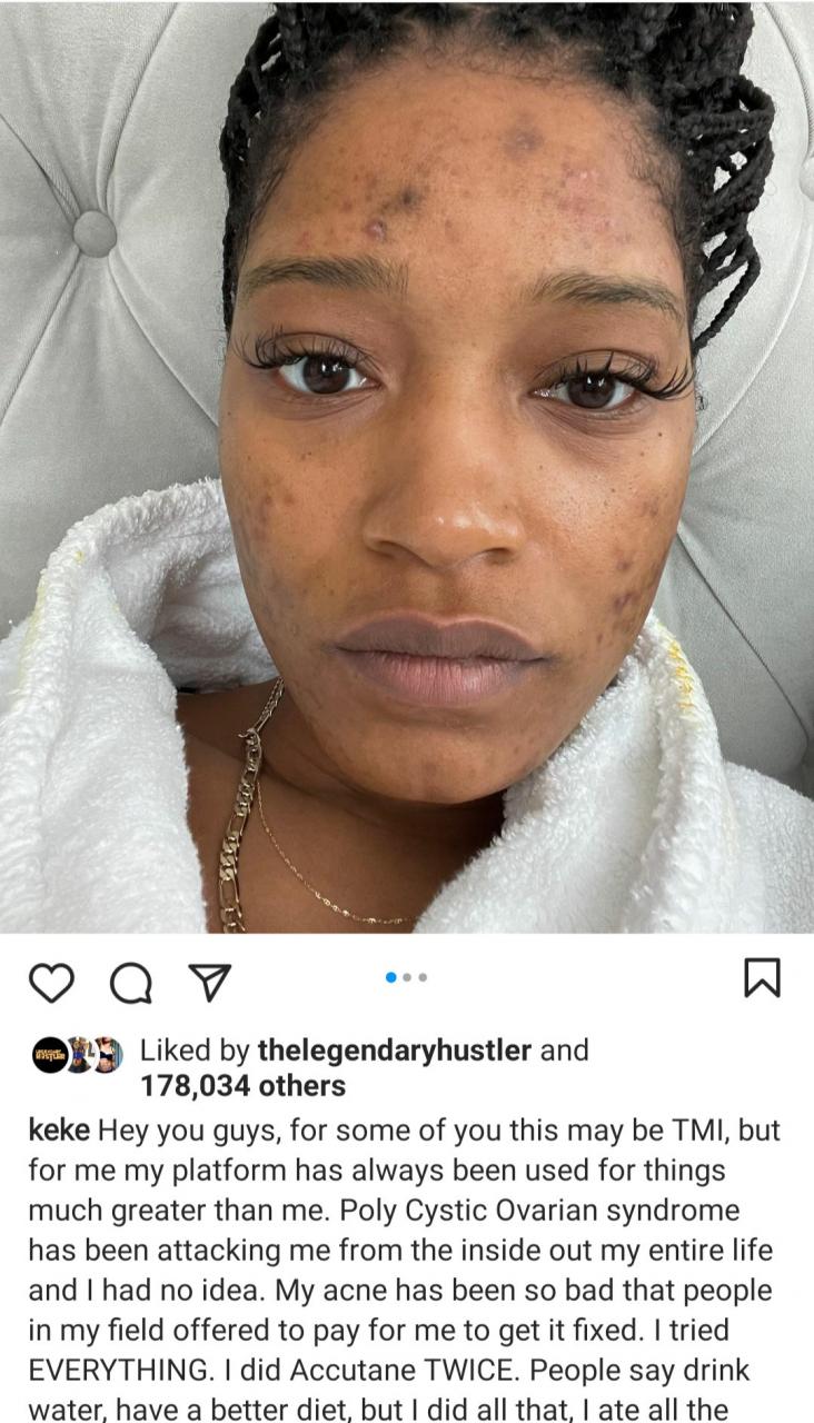 "My skin has made me sad many nights" Keke Palmer says as she reveals her struggle with acne caused by PCOS