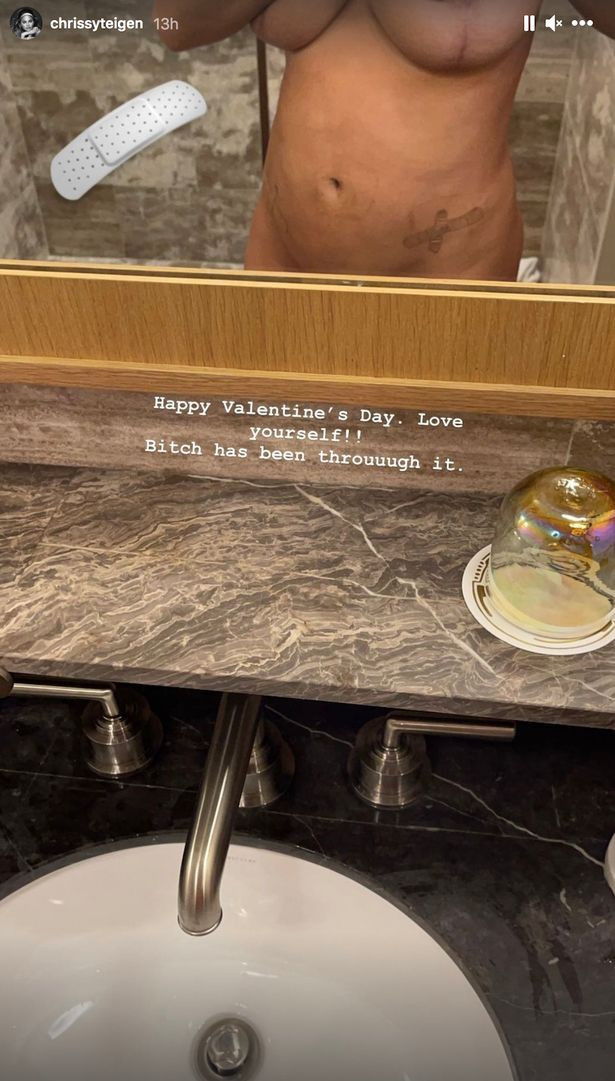 Chrissy Teigen poses nude to show off scarred figure after surgery