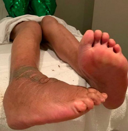 Wendy Williams shares?painful-looking photo of her swollen foot following battle with?lymphedema disease