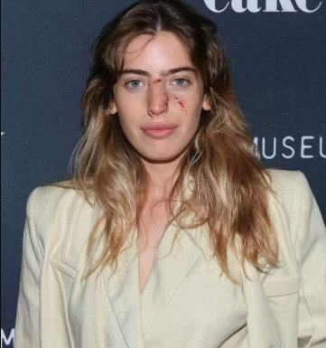Actress Clara McGregor shows up on red carpet with bloodied face after she was attacked by dog