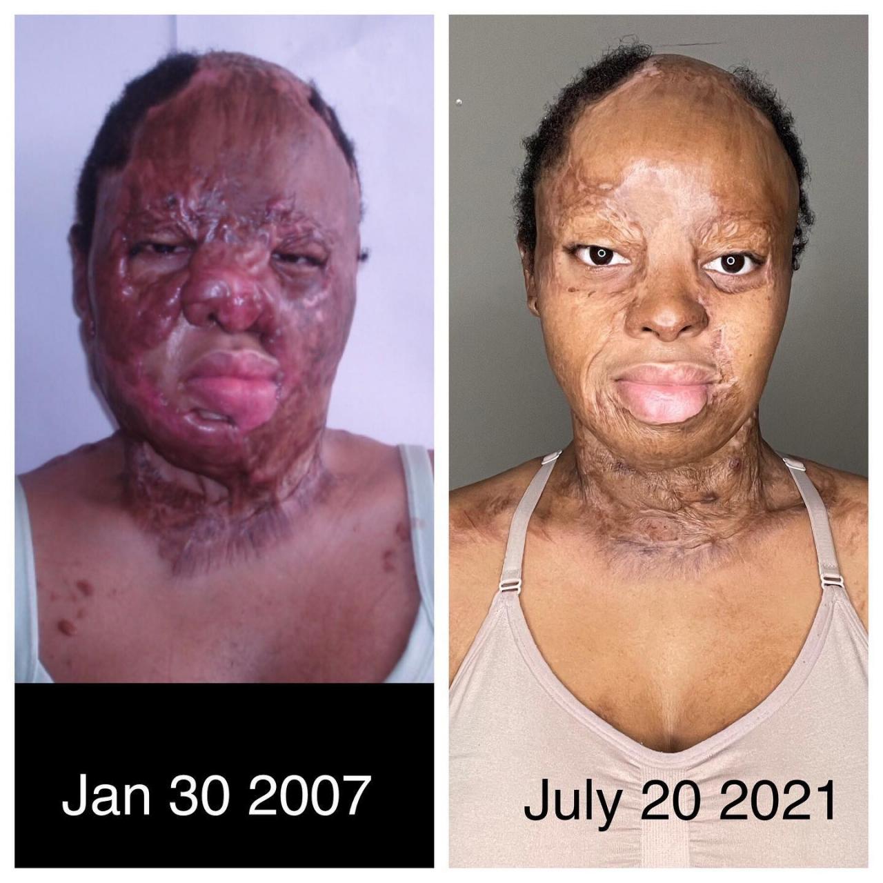 I?m grateful I lived long enough to see it - Plane crash survivor, Kechi Okwuchi bares her facial scars as she shares recovery journey