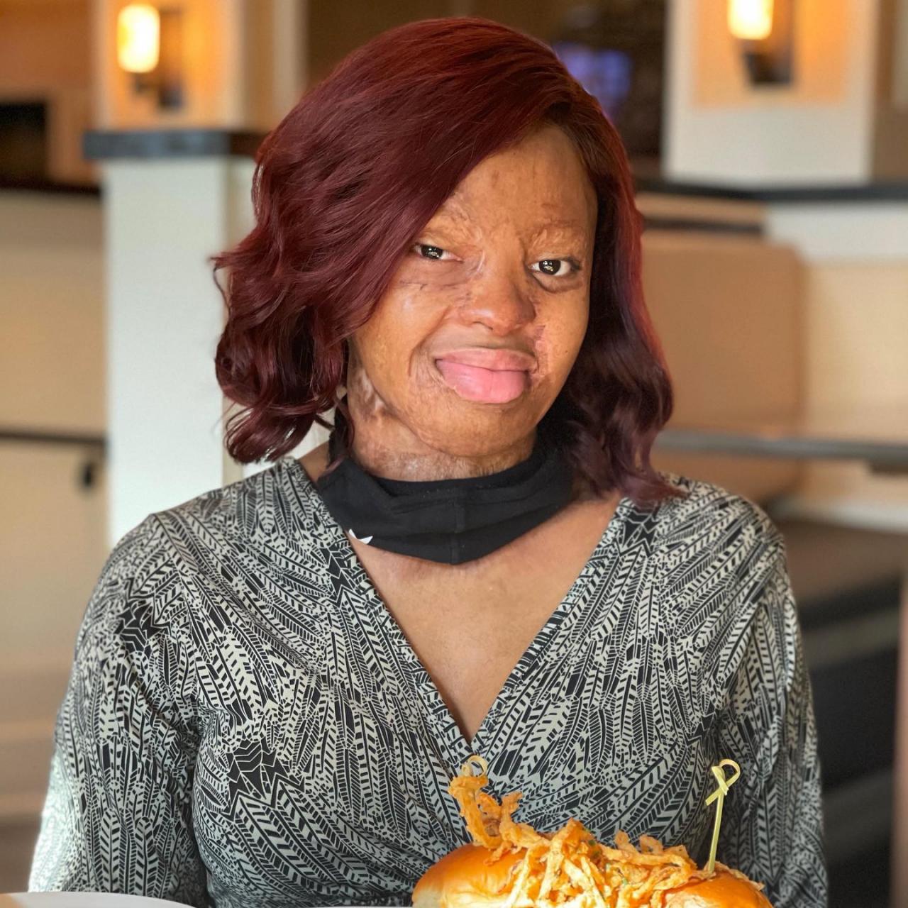 I?m grateful I lived long enough to see it - Plane crash survivor, Kechi Okwuchi bares her facial scars as she shares recovery journey 