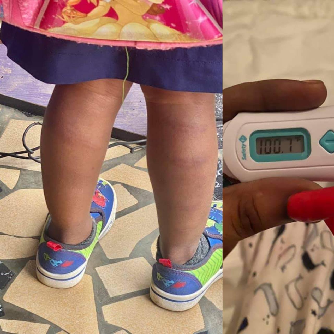 3-year-old pupil left badly bruised after she was flogged by teacher