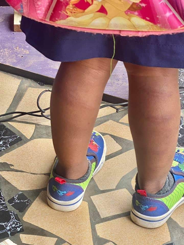 3-year-old pupil left badly bruised after she was flogged by teacher