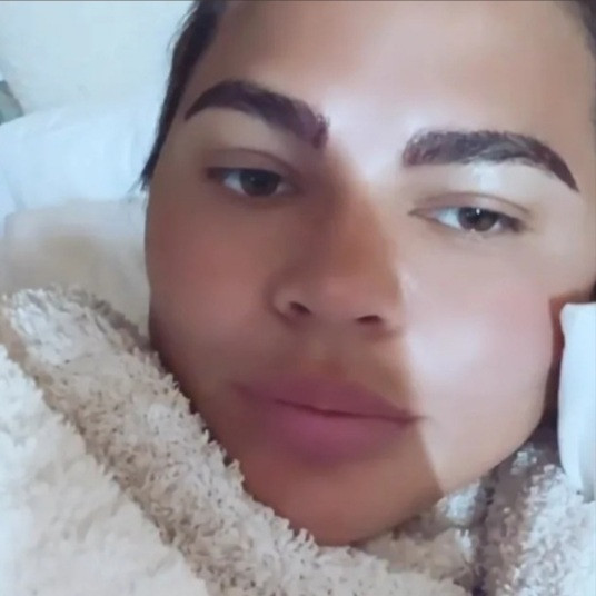 Chrissy Teigen receives hate after getting eyebrow hair transplant surgery