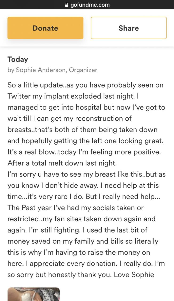 Lady left with deflated boobs after her implant exploded (video)