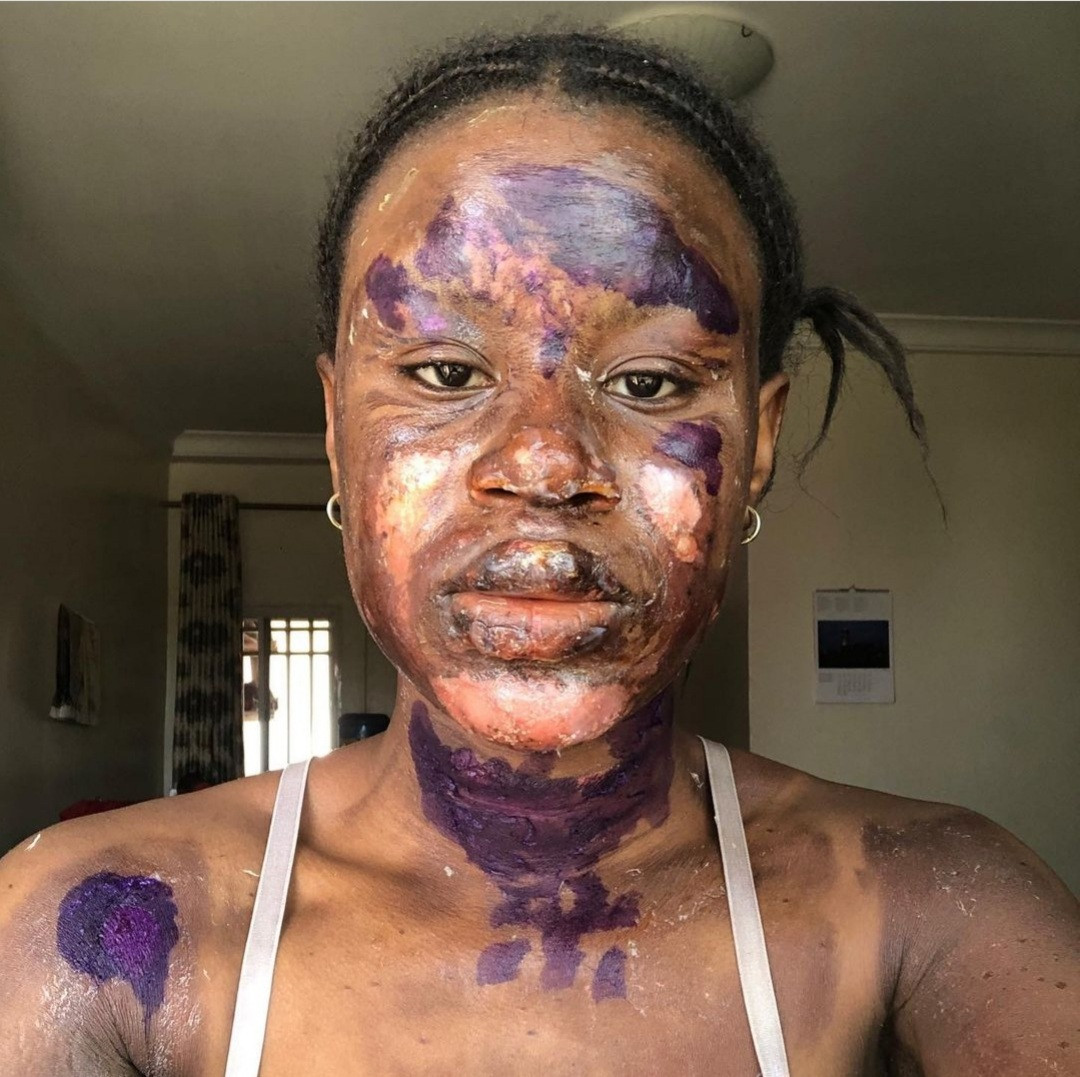 Burn survivor shows off her amazing transformation as skin heals without blemish