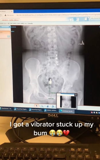 Woman ends up in hospital for surgery after getting vibrator stuck up her bum
