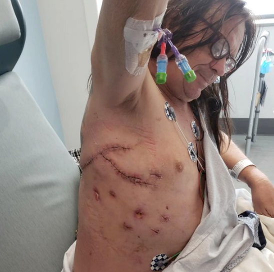Legendary sword swallower pierces his abdomen,?liver?and loses part of his lung during practice