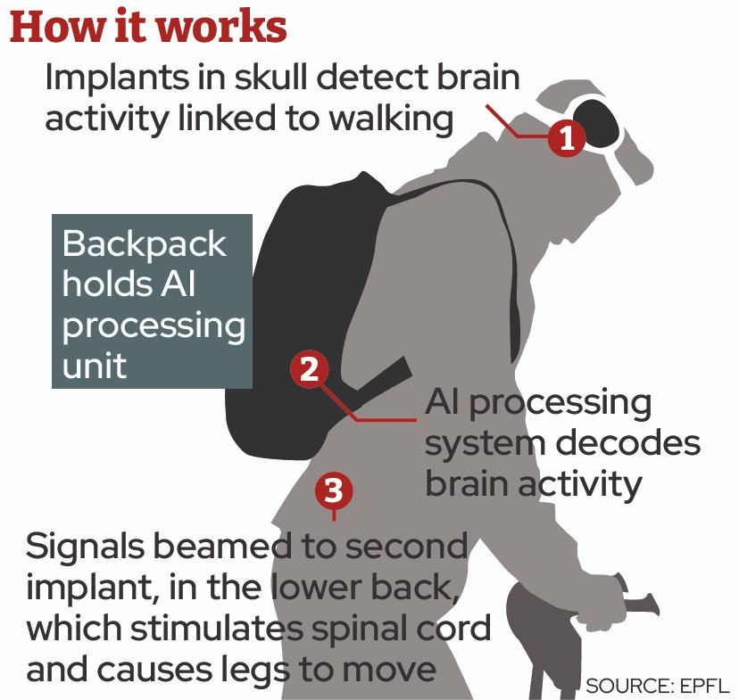 40 year old Paralyzed man walks again using new AI implants that connect his brain with spinal cord