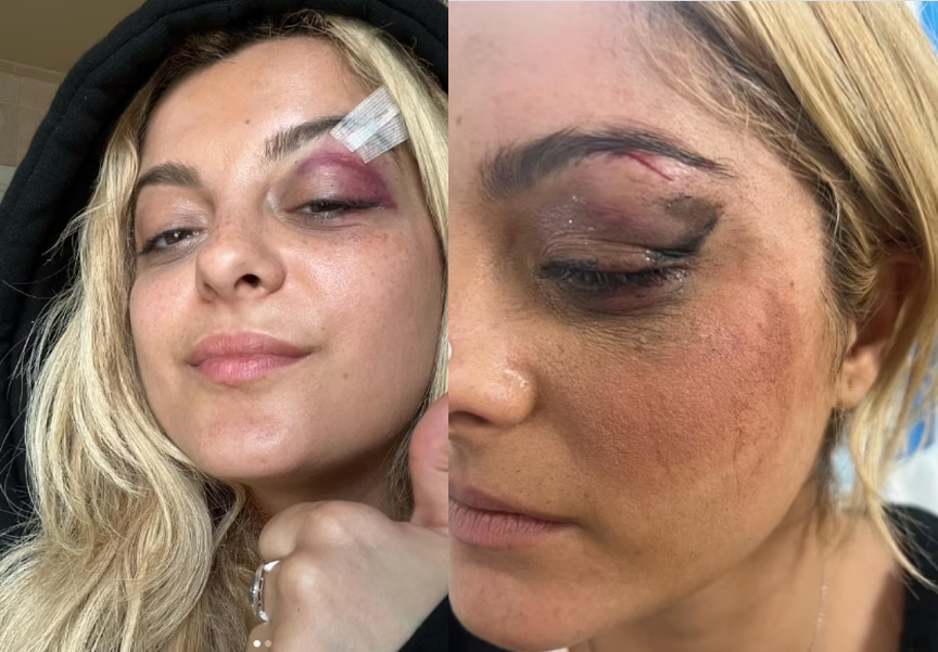 US singer, Bebe Rexha shows off her painful injuries after being hit in the face with a phone�during�concert (photos)
