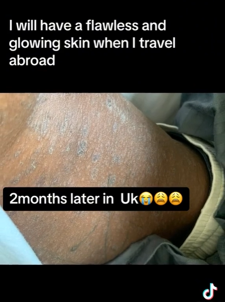 Lady recounts how she battled a skin issue after thinking she would have a flawless skin upon arriving UK