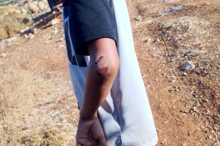 injured arm